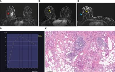 Application value of MRI-guided wire localization to the non-palpable breast lesions only shown in Breast MRI